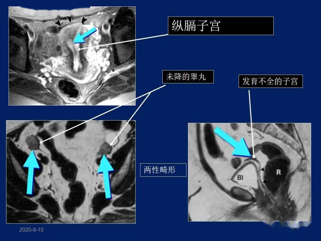 妇产科常见疾病mri表现_子宫