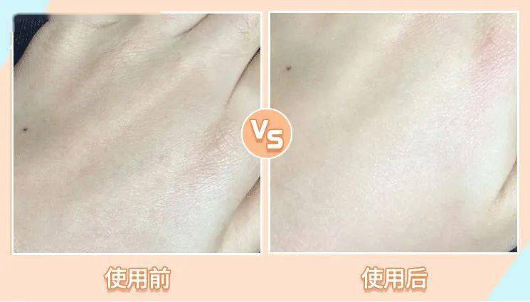 肌肤|因为粗糙的手,丢了颜值还越来越自卑,还好有它拯救了....