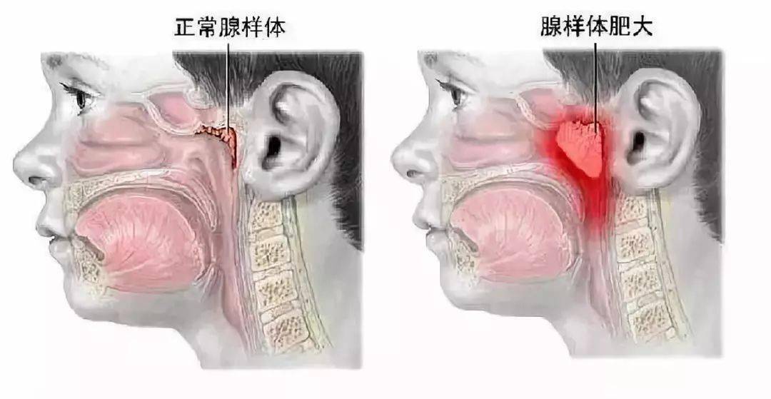 腺样体肥大致鼻呼吸不畅 张口呼吸引起面部变形 余斌介绍说 腺样体也