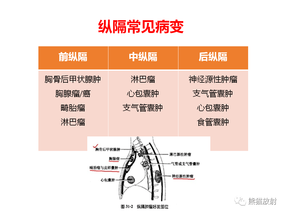 【省立影像读片】后纵隔肿瘤 20.09