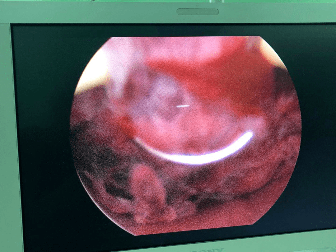 王优君主任即行电切术,电切组织逐渐增多,宫腔逐渐