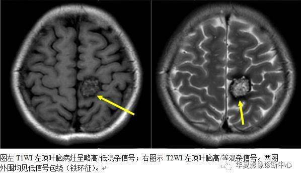 值得收藏的颅脑21种影像征像_脑膜