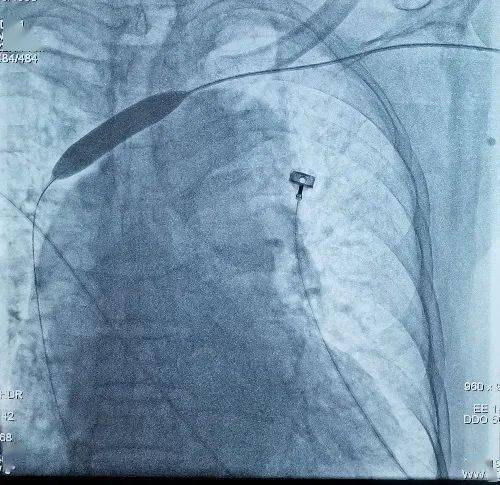 手臂|尿毒症老人求助：透析手臂血管通往心脏的“路”窄了！医生用小小球囊疏通“生命线”