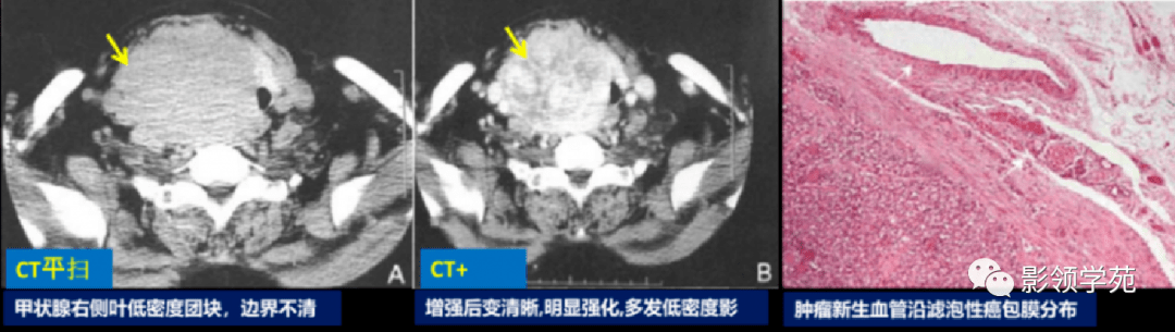 5种常见的甲状腺结节性病变影像表现