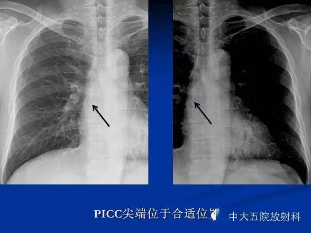 胸部正位片验证picc