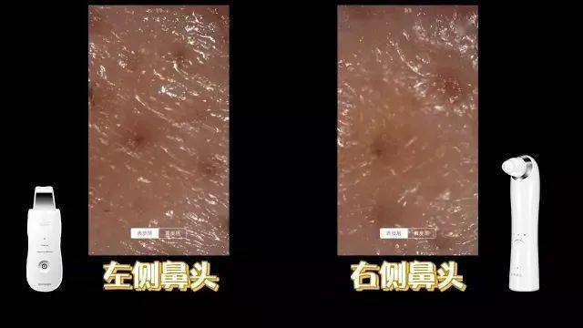 鼻子|米粒大的黑头，瞬间吸出，整个鼻子新生了！