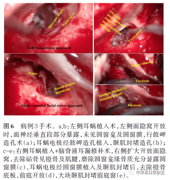 其中病例1术后脑脊液耳漏,经抗炎,卧床等保守治疗好