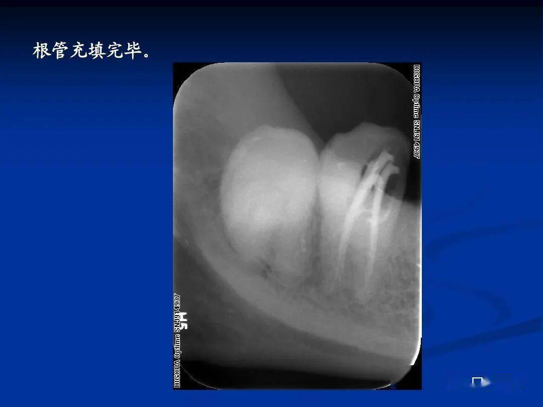 c型根管的特点及解析