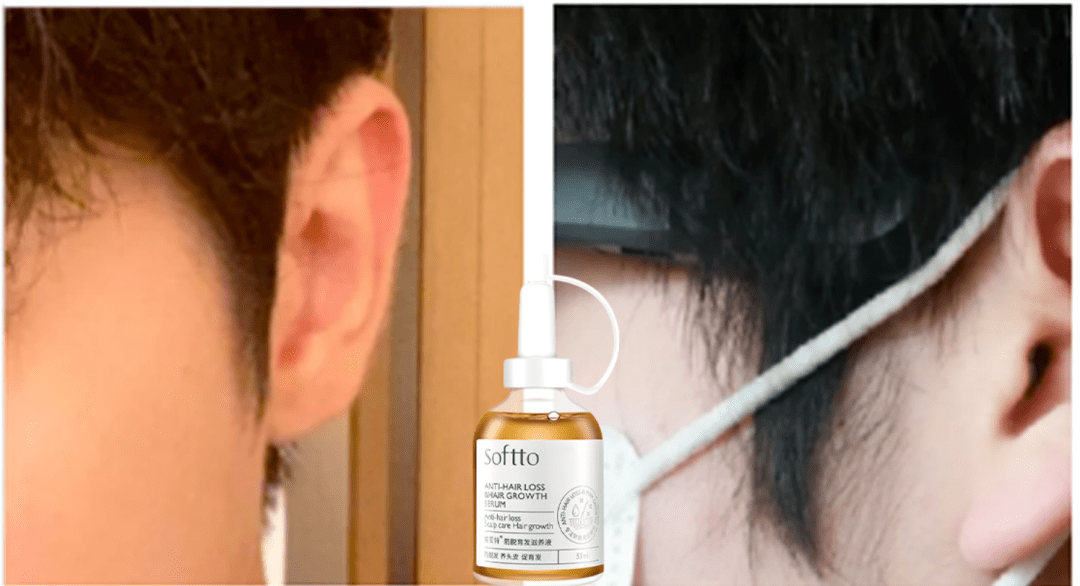索芙特|超强国货生发!1个月发际线被填满,半年发量暴增!