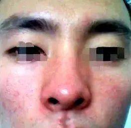 肝脏|【健康知识】肝病早期有7个症状，4个地方会变红，3个部位会变黄