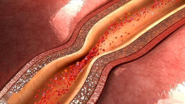 低密度脂蛋白高密度脂蛋白都正常 f7b2831c3c9f4919bad846fd19ea0d1d.jpeg