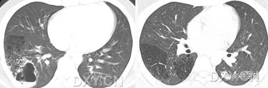 11种肺部囊样病变的影像表现