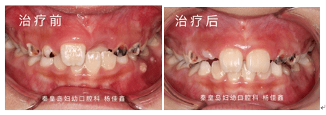 治疗|最佳时机别错过！孩子牙齿矫正