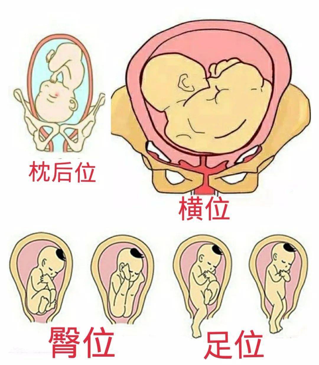 临床上常见的有臀位,横位,枕后位以及足位等异常胎位,多见于腹壁松弛