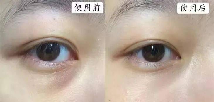 黑眼圈|马应龙新款眼霜买1送5，拼网速抢购中！早晚用一次，轻松缓解黑眼圈、浮肿眼袋、细纹皱纹，40岁阿姨也能抹出少女眼！