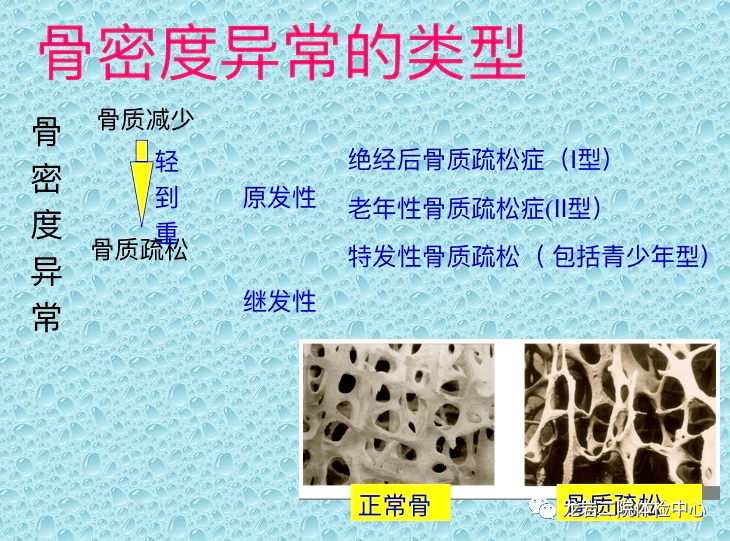 骨密度异常及其预防