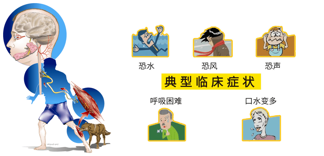 狂犬病又名恐水症,临床表现为特有的恐水,怕风,恐惧不安,流涎,咽肌