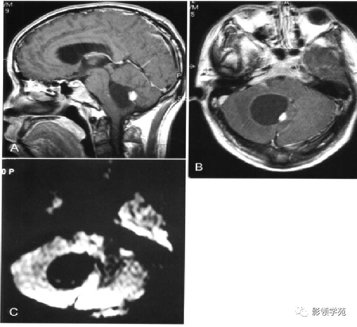 脑实质内囊性病变影像表现_囊虫