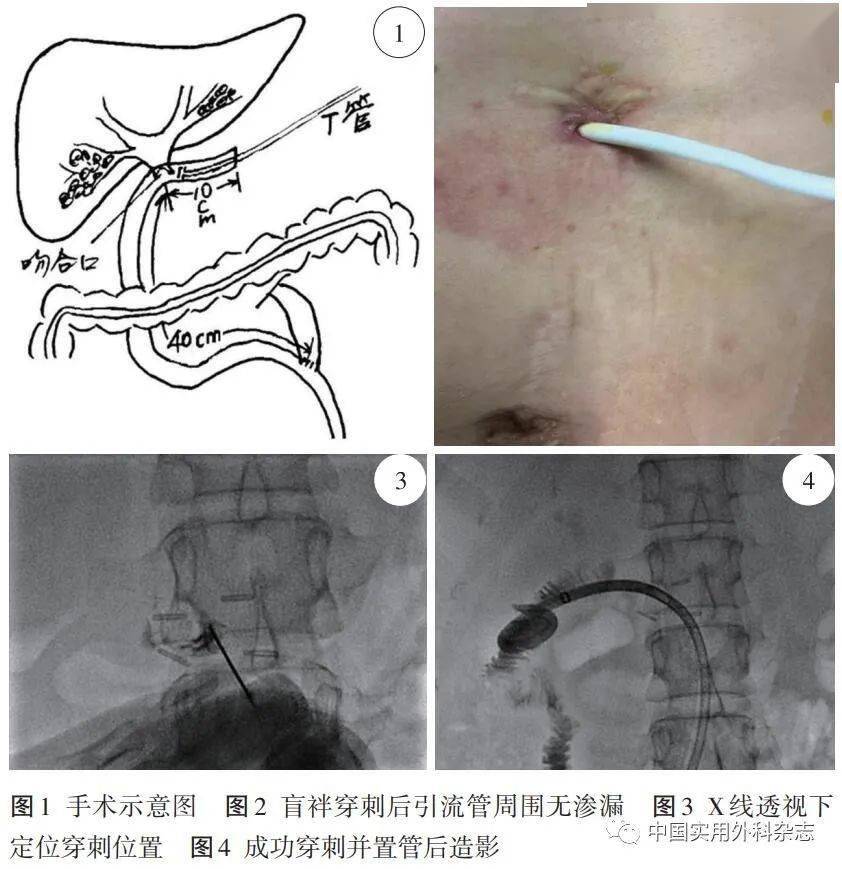 论著|胆管空肠吻合联合空肠盲袢固定标记在复发肝胆管