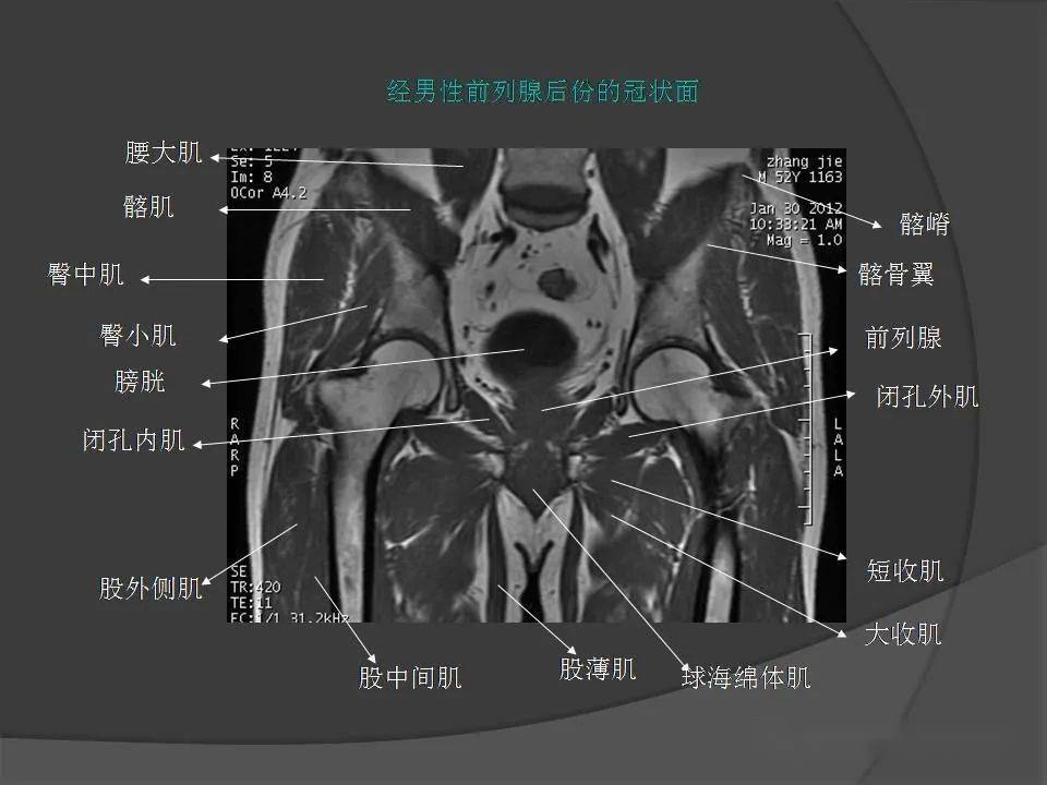 骨盆肌肉mri断层解剖