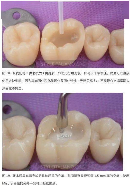 【牙医学堂】后牙ii类洞邻壁的处理