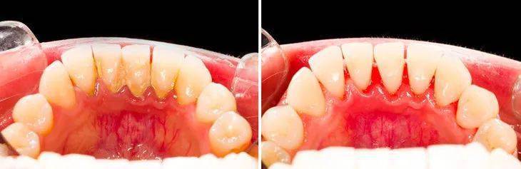 口腔|不到60元的电动牙刷，用起来竟然不输百元大牌！2分钟清洁整个口腔，性价比逆天！