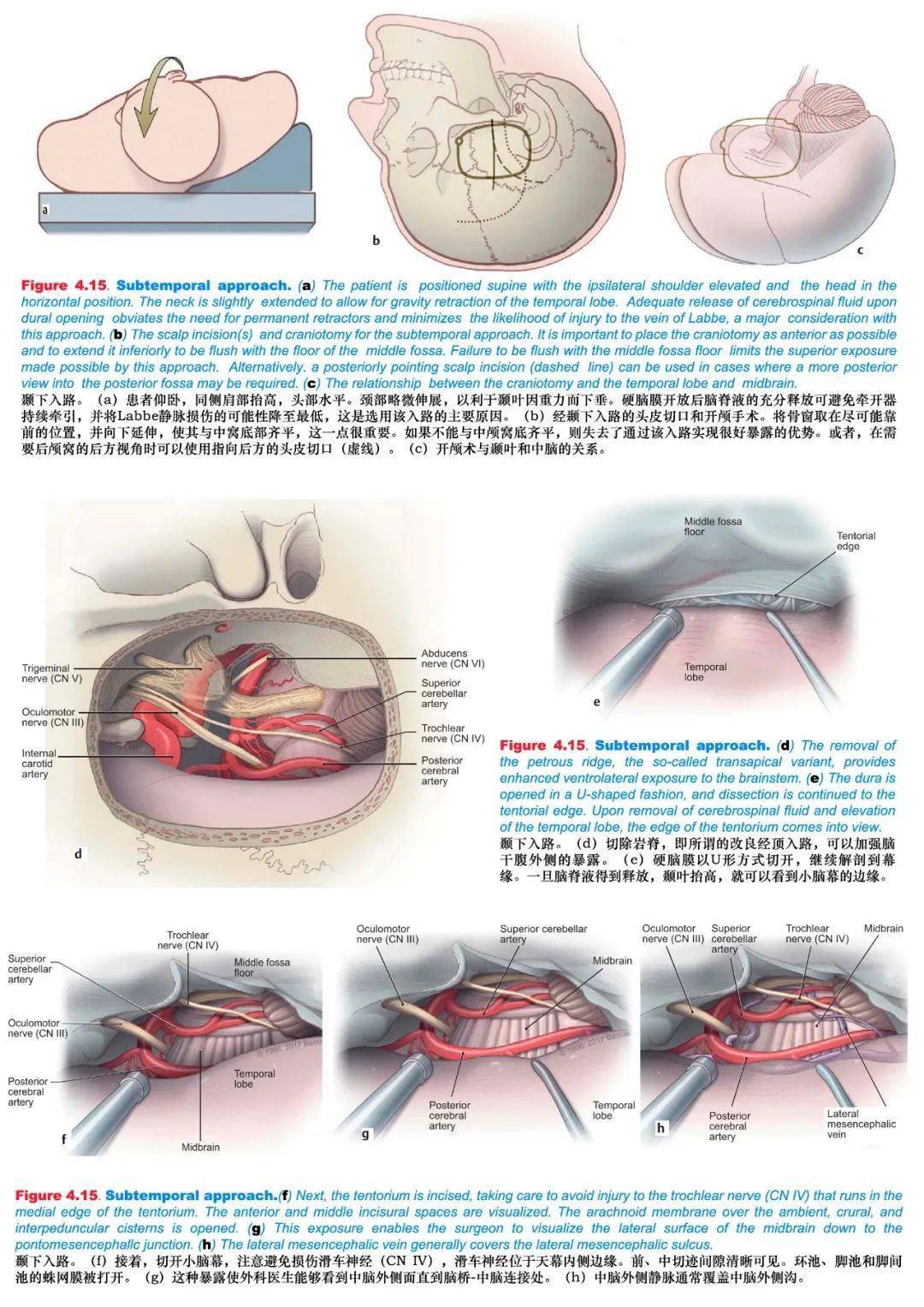 【经典】神经外科手术入路总结与图示