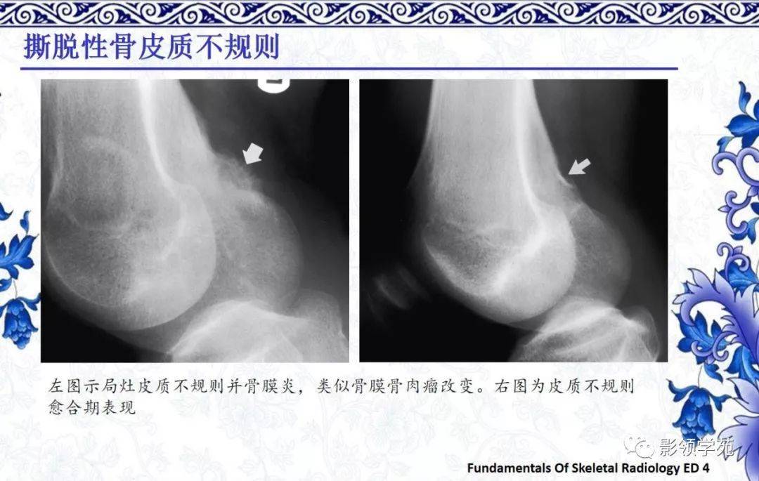 【经典回顾】非骨化性纤维瘤