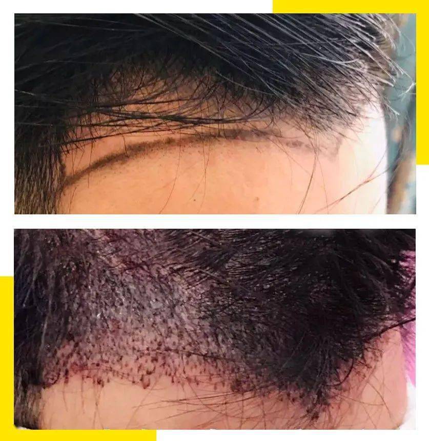 移植|国庆回去，我打算植发了！