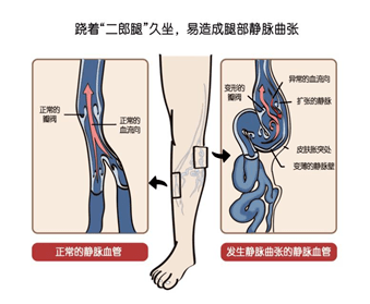 1,形成静脉曲张:跷着"二郎腿"久坐,由于双腿互相交叠,还会妨碍腿部