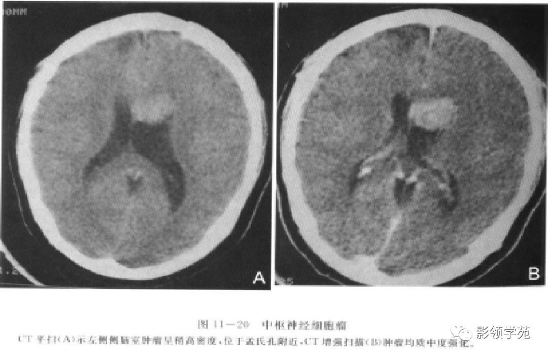 神经上皮囊肿可以位于脉络膜丛和脑室,偶尔也可以位于脑实质内.