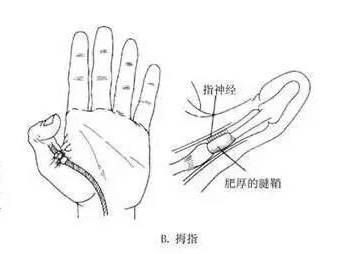 人均腱鞘炎_手腕腱鞘炎图片(2)