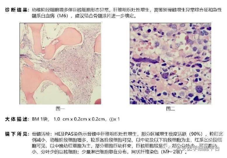 什么是骨髓增生异常 ef16f44a8f0d4b4691cf084ea78368c8.jpeg