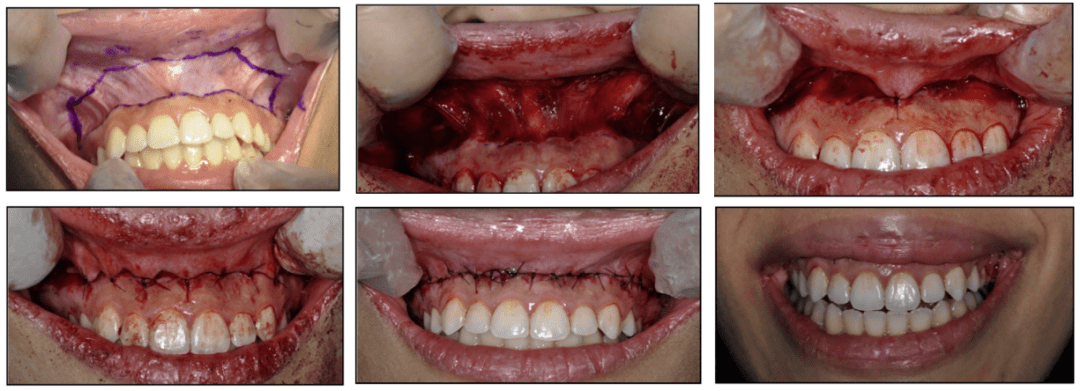 露龈笑治疗方法之上唇再定位_手术