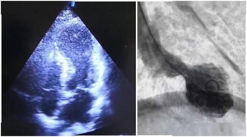 段运动|伤心欲绝居然真的会“心碎”，此病发作时心尖变“章鱼篓”