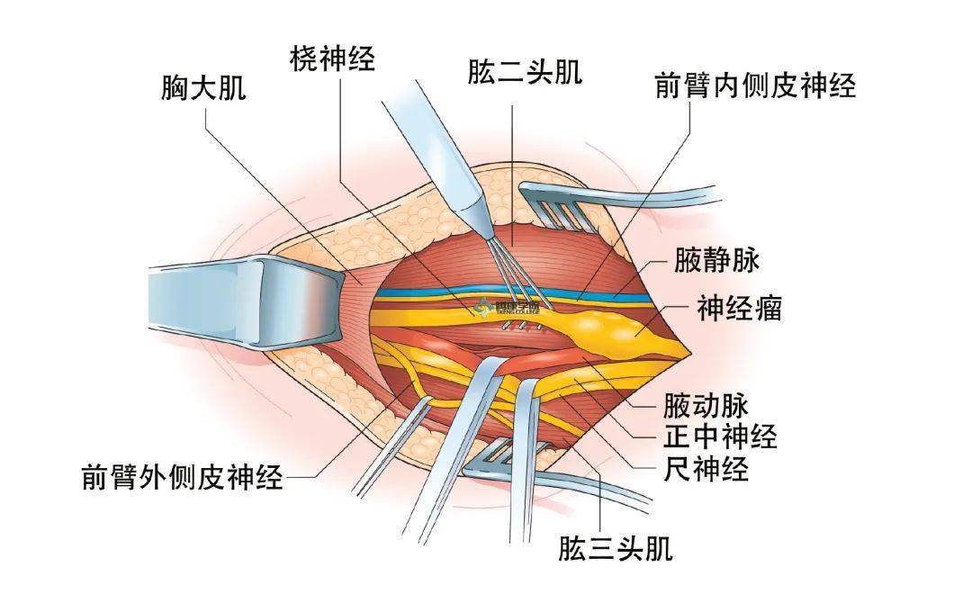 桡神经临床表现和检查