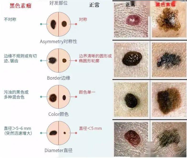 d 直径(diameter) 位于手掌,足底,手指甲,脚趾甲的痣,直径(宽度)大于3