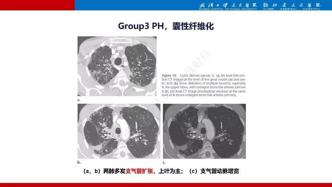 肺动脉高压临床分类及ct表现