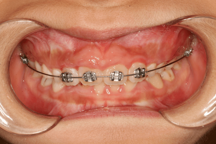 病例前牙阻生正畸牵引案例分享