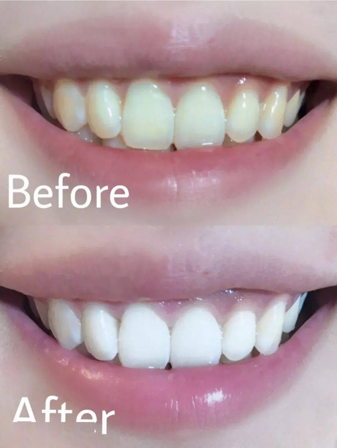 清洁|电动牙刷真的比普通牙刷好吗？我替你们问了医生