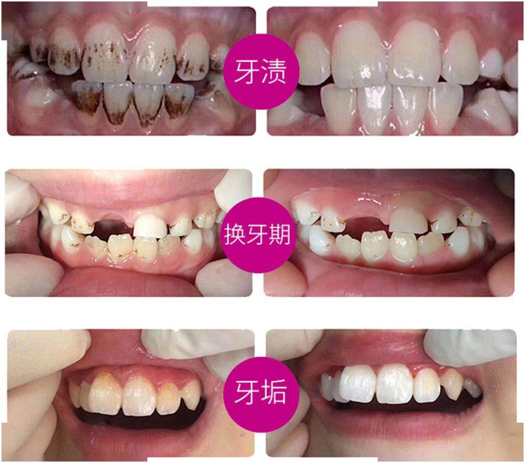 牙膏|揭秘！全球80万牙医不洗牙的秘密...