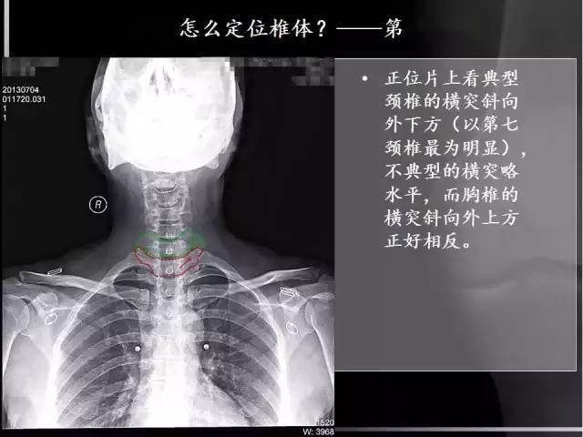 x线解剖详细颈椎x线解读图文标注版