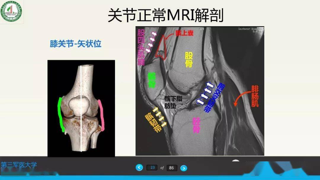 超赞这个满分膝关节韧带mri诊断课件有视频课程了