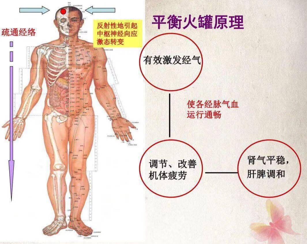 你所不知道的拔罐疗法——平衡火罐