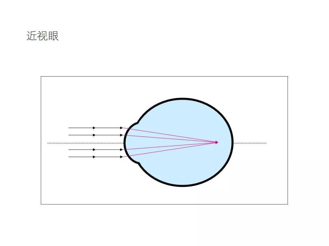 近视眼在视网膜前成像.
