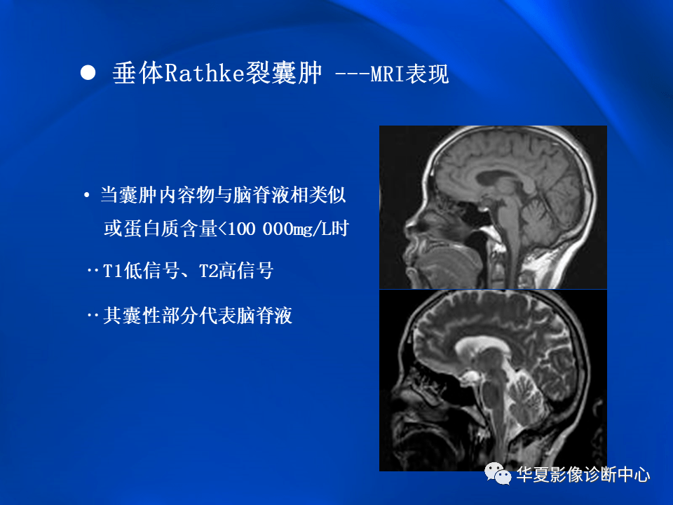 垂体rathke裂囊肿mr表现