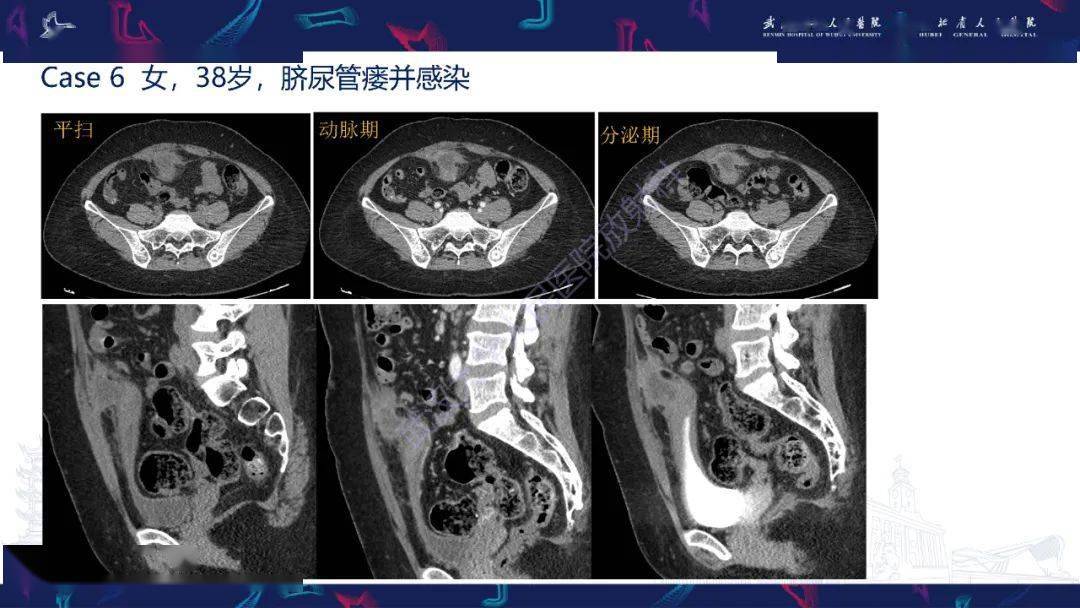 脐尿管病变影像诊断