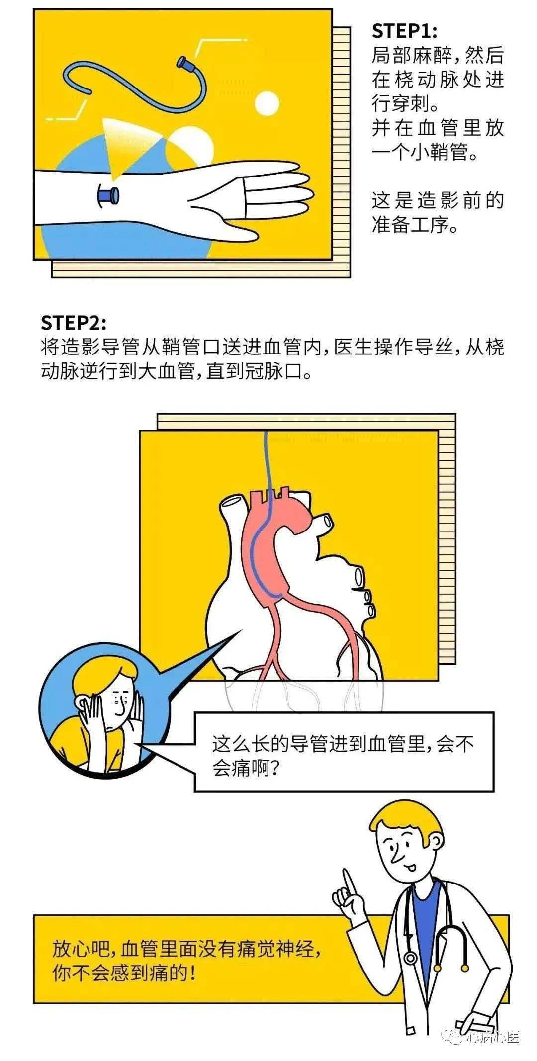 一台完整的pci手术是如何完成的?