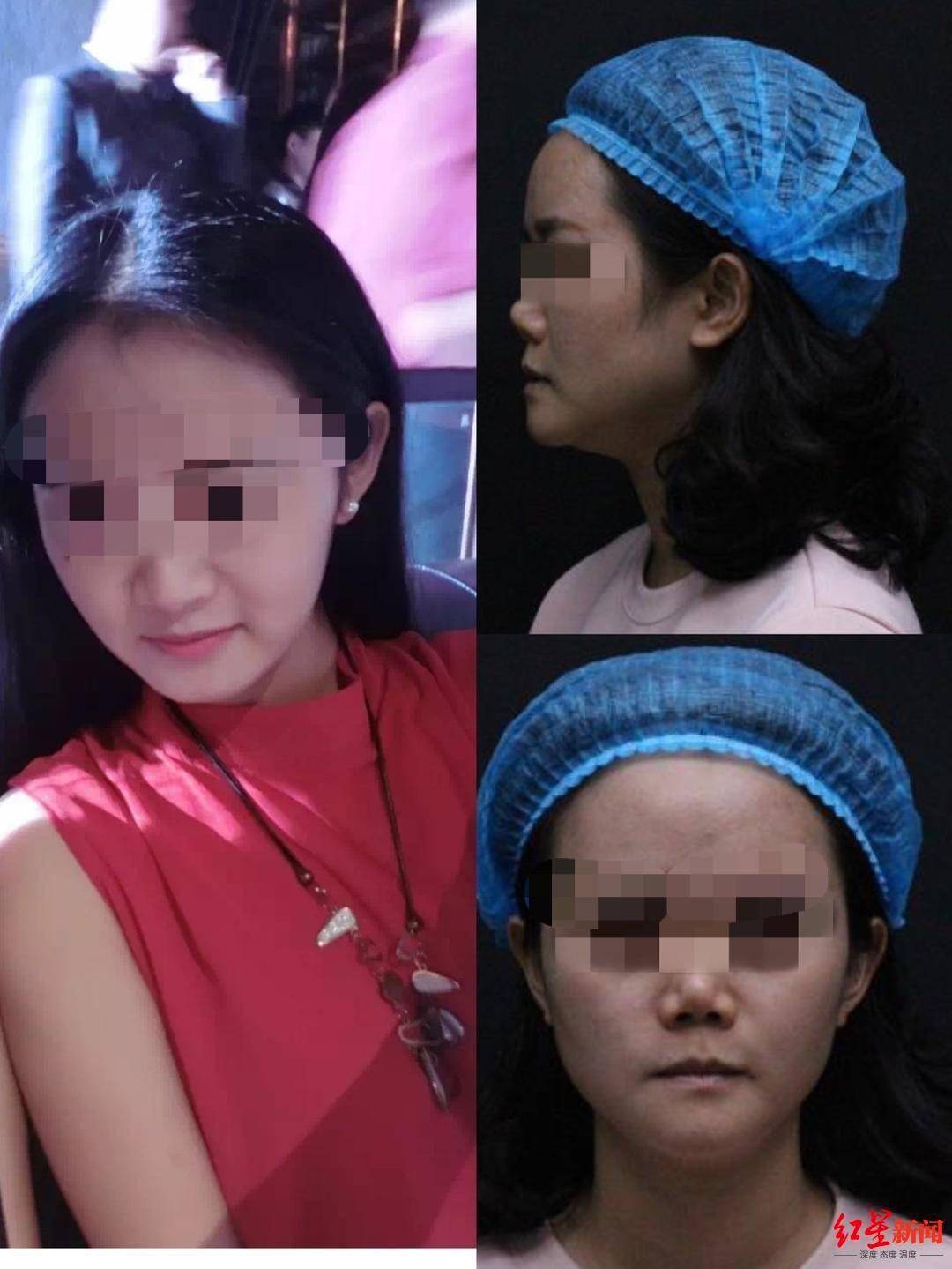 恒达官网整形悲剧:“成都赵丽颖”没当成,鼻子还变形 院方:手术确实出了问题 (图8) 恒达官网整形悲剧:“成都赵丽颖”没当成,鼻子还变形 院方:手术确实出了问题 (图8)