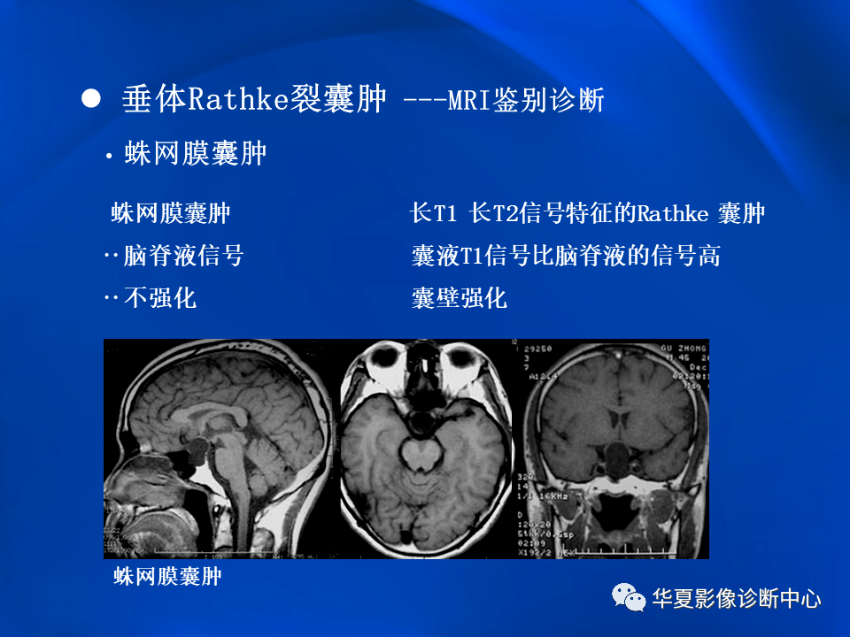 垂体rathke裂囊肿mr表现